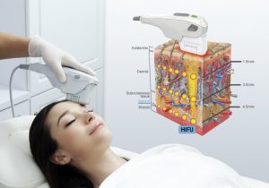 RT Aesthetics HIFU - High Intensity Focused Ultrasound