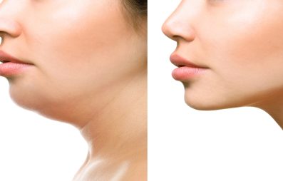 Double Chin Reduction Newcastle - RT Aesthetics - North East