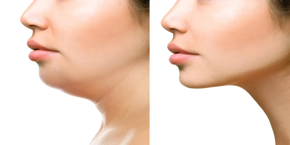 How to get rid of neck fat sale