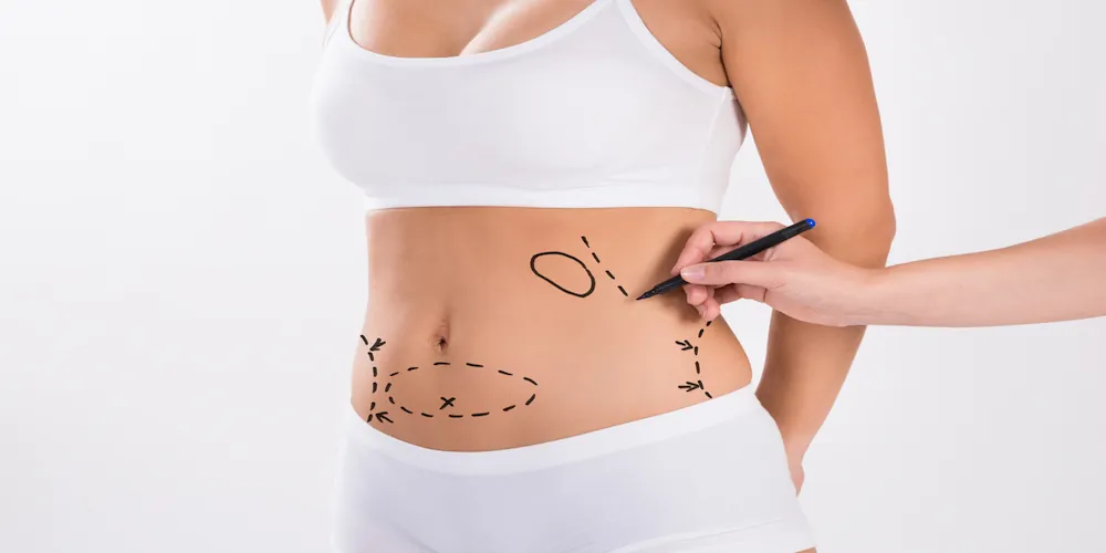 Liposuction Newcastle , Fat Freezing Newcastle, Fat Freezing Near Me