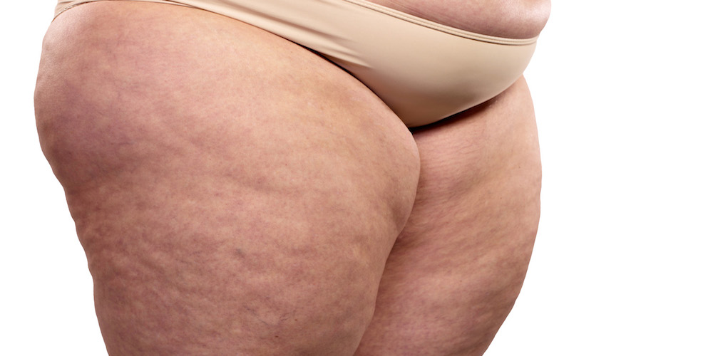 Common Causes of Cellulite Newcastle RT Aesthetics