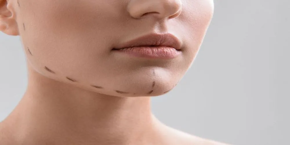 Chin Liposuction Newcastle