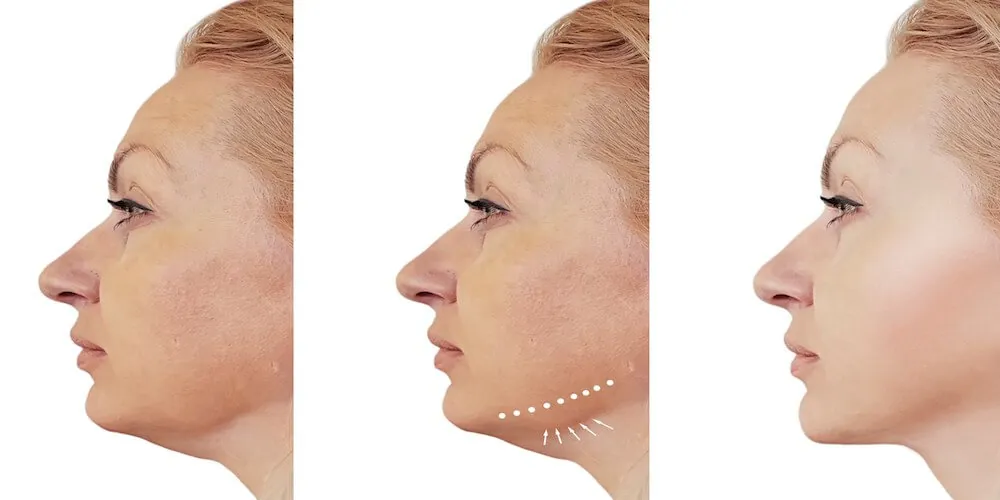 jowls treatments