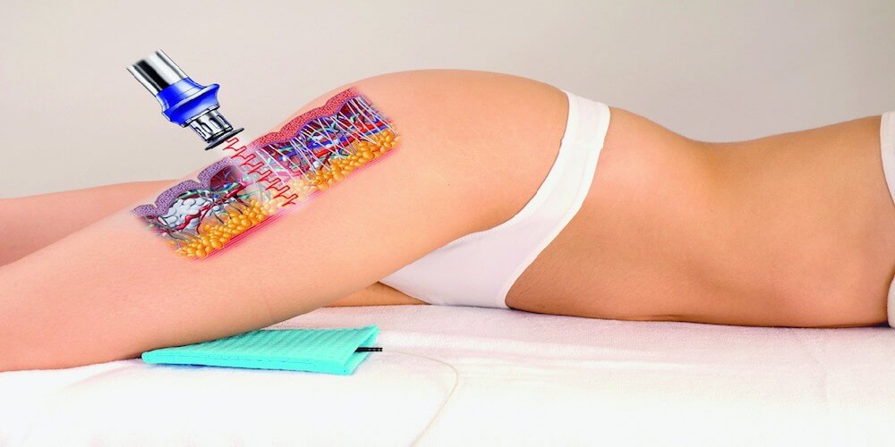 Shockwave Therapy for Cellulite Treatment