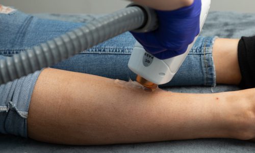 Laser Hair Removal Newcastle