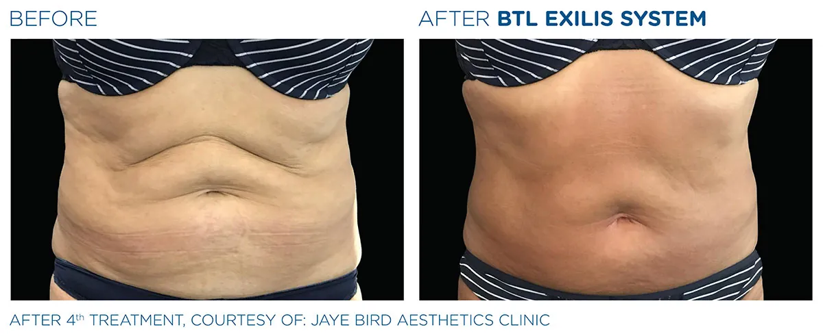 BTL Exilis Ultra Body In Newcastle