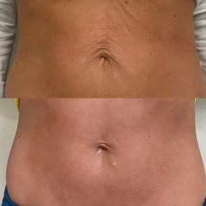 HIFU Body Treatment - Before and After Photo