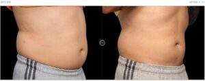 BTL Exilis Stomach Before and After Photo