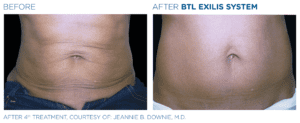 Stomach Before & After Exilis Body Treatment