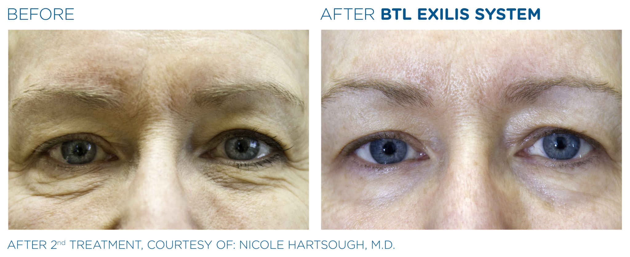 BTL Exilis® Ultra Face