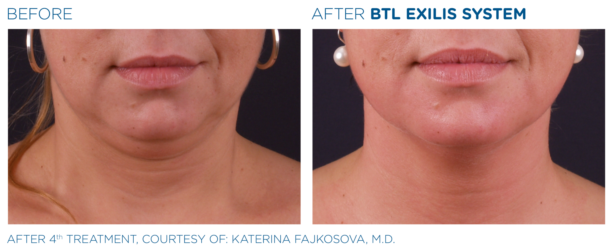 BTL Exilis® Ultra Face