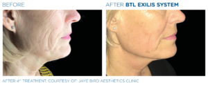 Before and After Photos of BTL Exilis Face