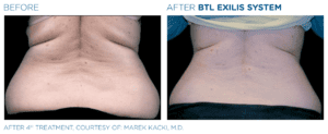 Back Fat Before & After Exilis Body Treatment