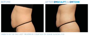 EMSculpt Stomach Treatment