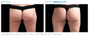 EMSculpt Neo Bum Treatment