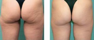 BTL Exilis bum and leg Before and After Photo