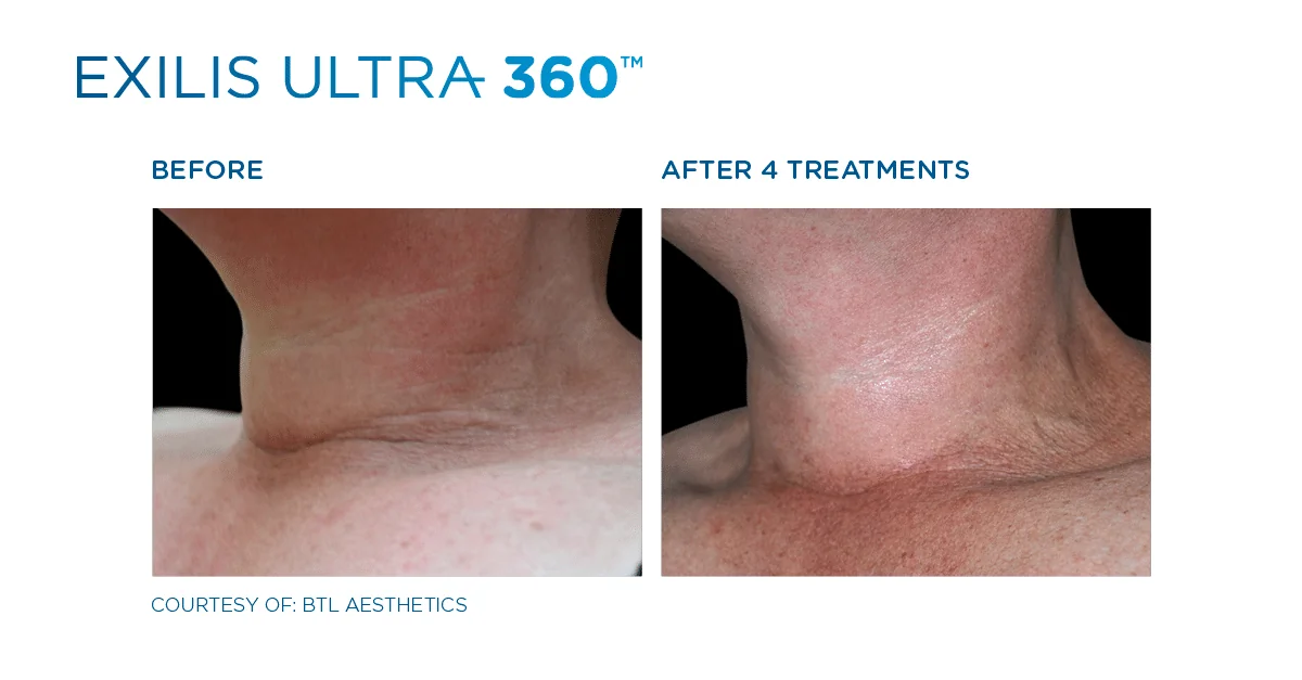 BTL Exilis® Ultra Face