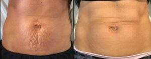 HIFU Body Treatment - Before and After Photo