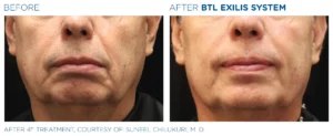 Before and After Photos of BTL Exilis Face