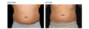 BTL Exilis Stomach Before and After Photo