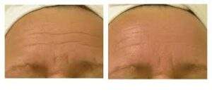 HydraFacial before and after Newcastle