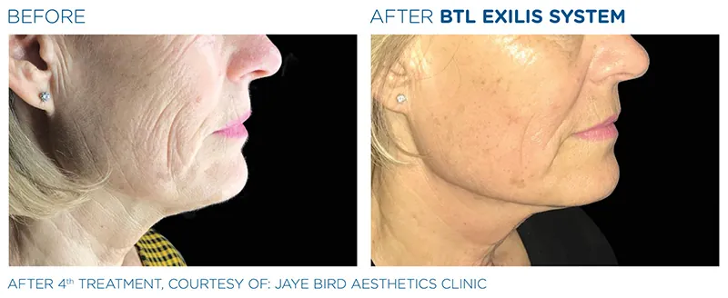 BTL Exilis® Ultra Face