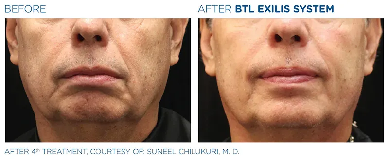 BTL Exilis® Ultra Face