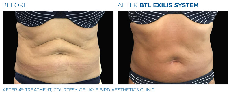 BTL Exilis® Ultra Body