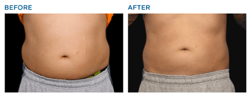 BTL Exilis® Ultra Body