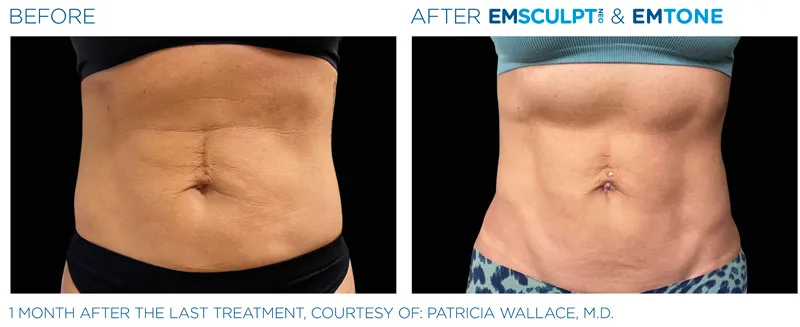 EMSculpt Neo®