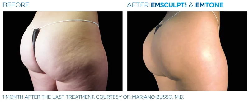 EMSculpt Neo®