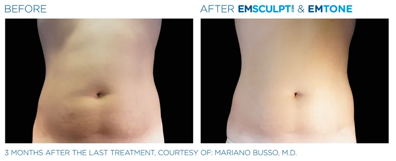 EMSculpt Neo®