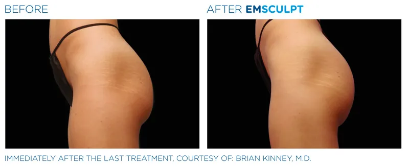 EMSculpt Neo®