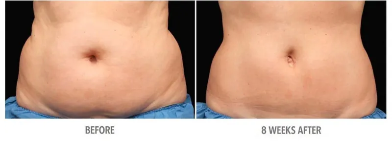 Cryolipolysis Newcastle