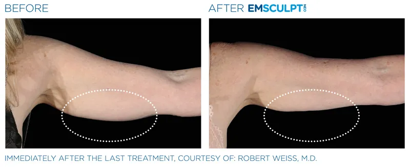 EMSculpt Neo®