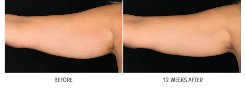 Cryolipolysis Newcastle