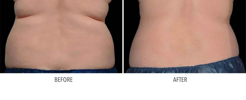 Cryolipolysis Newcastle