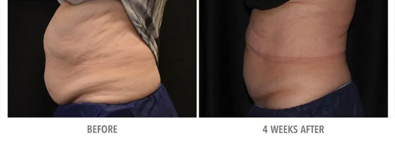 Cryolipolysis Newcastle