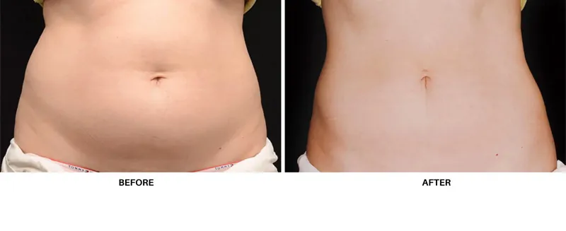 Cryolipolysis Newcastle