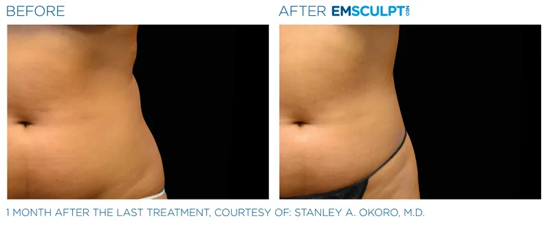 EMSculpt Neo®