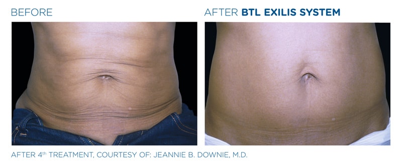 BTL Exilis® Ultra Body