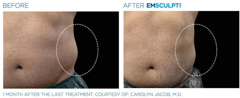 EMSculpt Neo®