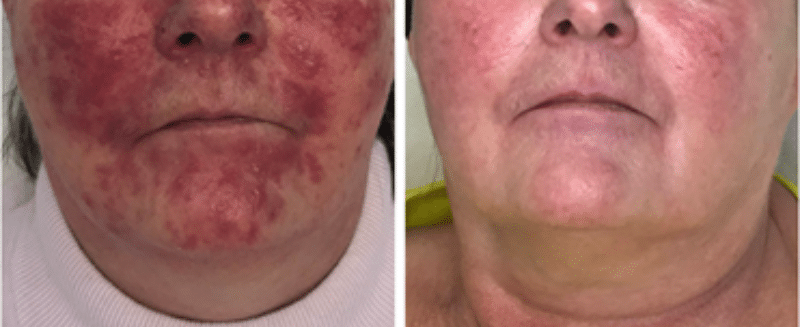 AlumierMD Chemical Peels