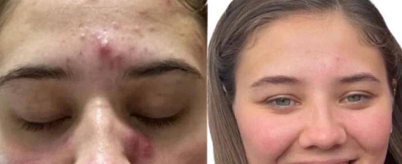 Before and after Alumiermd Chemical Peel younger skin