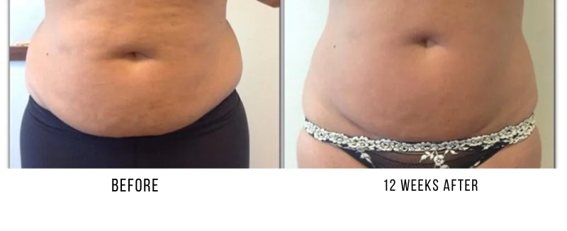 Cryolipolysis Newcastle