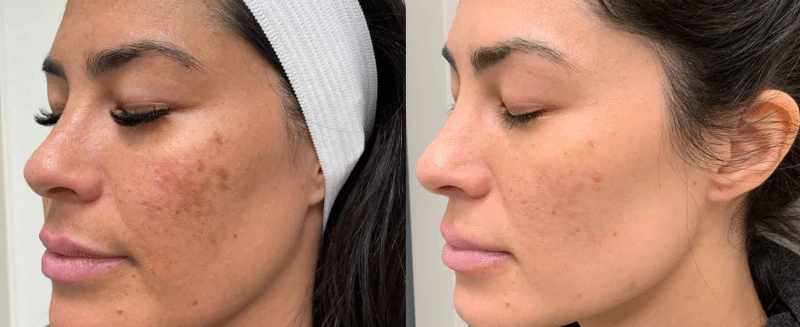 AlumierMD Chemical Peels