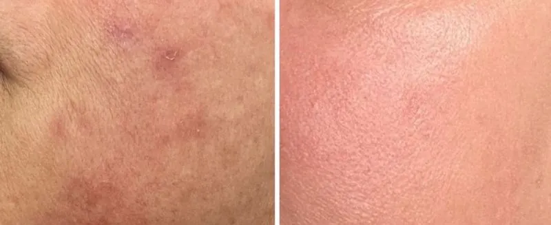 bio Needling Before Photo and After