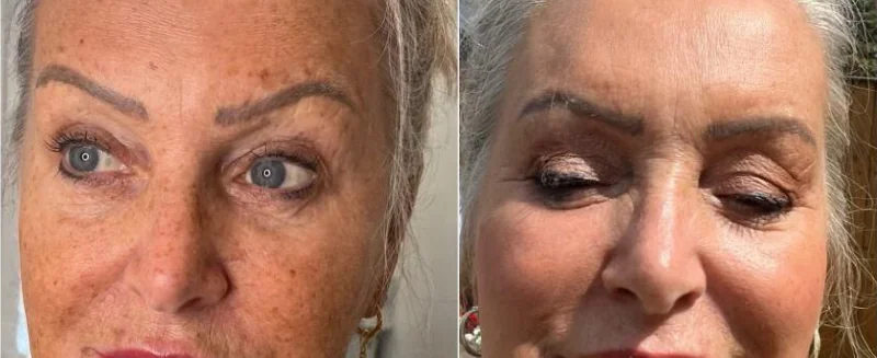 Bio Microneedling treatment before and after