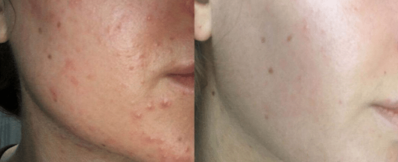 AlumierMD Chemical Peels