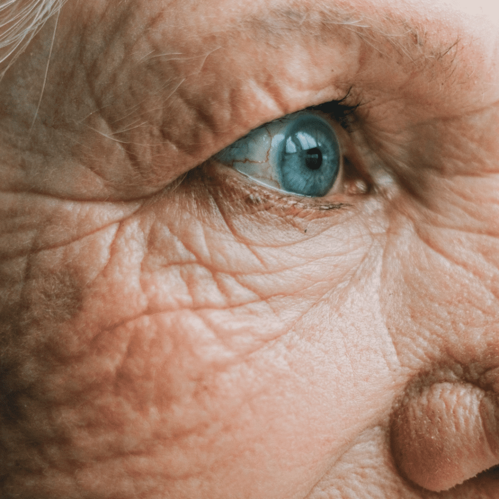 Wrinkle treatment results at RT Aesthetics Newcastle